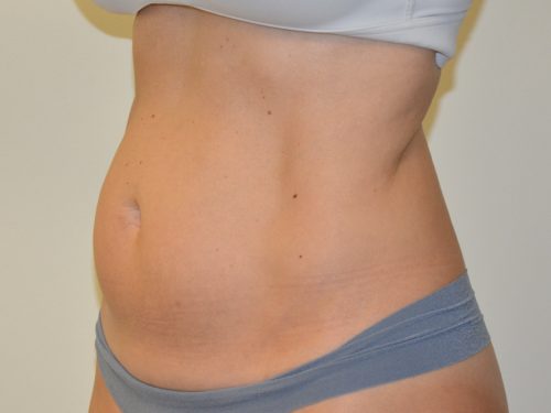 Liposuction Before Patient 2