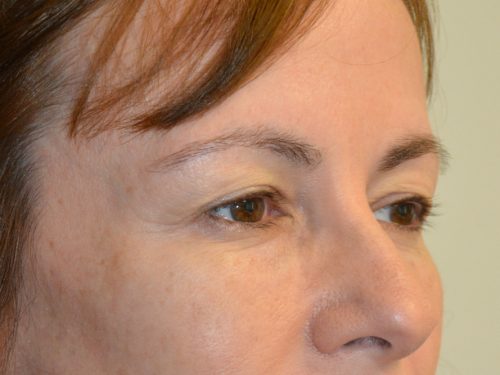 Eyelid Surgery Before Patient 2