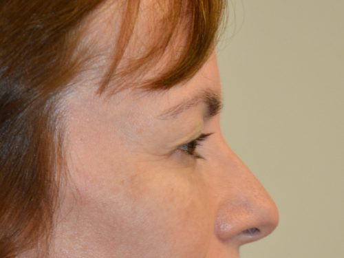 Eyelid Surgery Before Patient 3