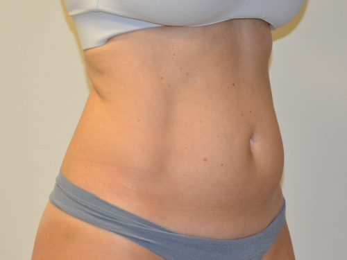 Liposuction Before Patient 4