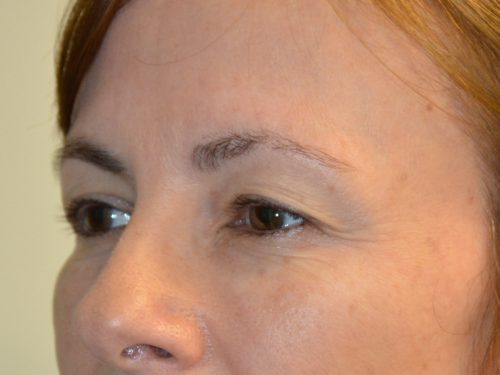 Eyelid Surgery Before Patient 4