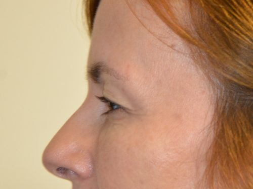 Eyelid Surgery Before Patient 5