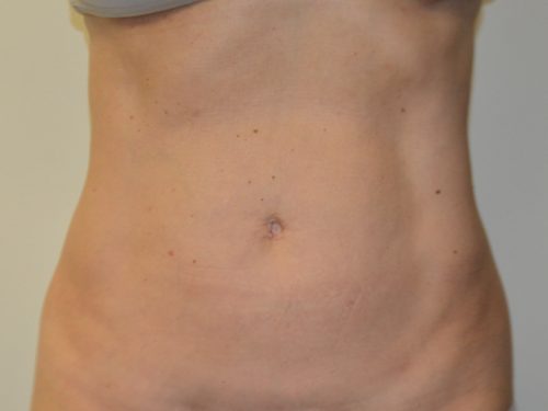 Liposuction After Patient 1