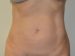 Liposuction After Patient Thumbnail 1