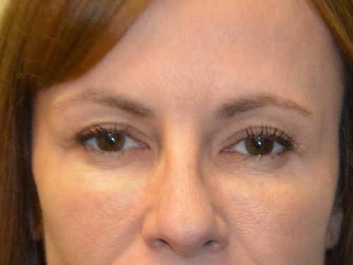 Eyelid Surgery After Patient 1