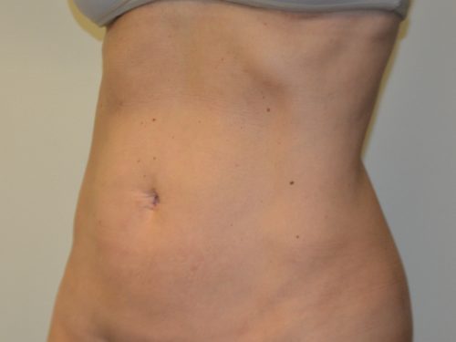 Liposuction After Patient 2