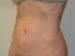Liposuction After Patient Thumbnail 2
