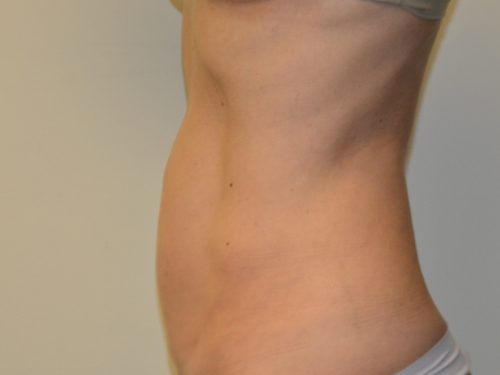 Liposuction After Patient 3