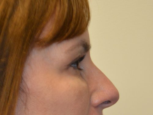 Eyelid Surgery After Patient 3