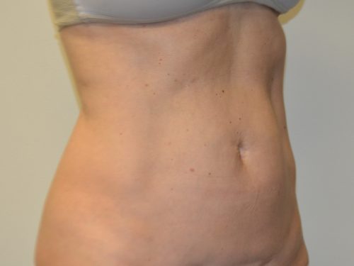 Liposuction After Patient 4