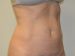 Liposuction After Patient Thumbnail 4