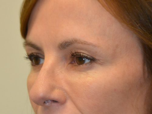 Eyelid Surgery After Patient 4