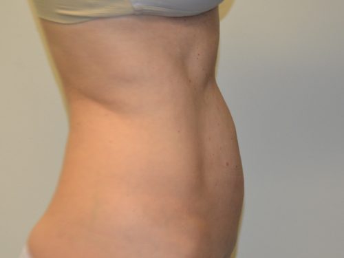 Liposuction After Patient 5