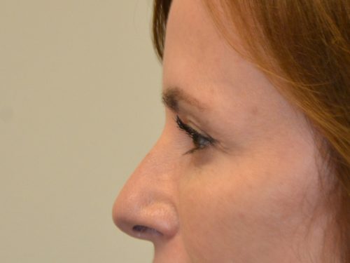 Eyelid Surgery After Patient 5