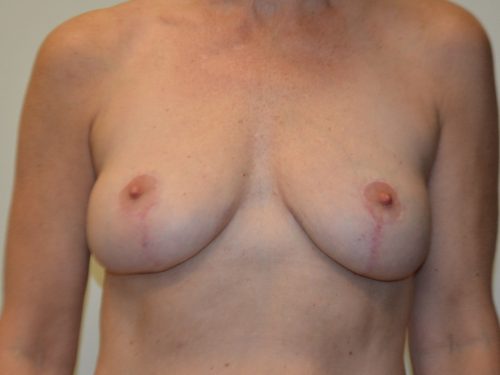 Breast Implant Removal After Patient 1