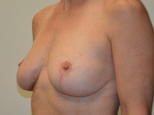 Breast Implant Removal After Patient 4