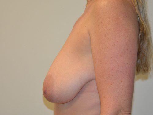 Breast Reduction Before Patient 3
