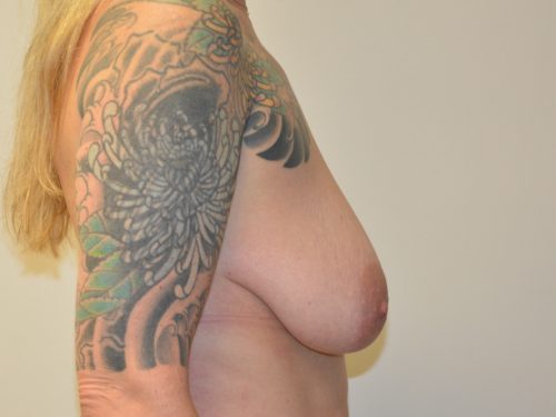 Breast Reduction Before Patient 5