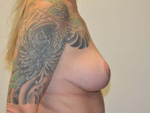 Breast Reduction After Patient 5