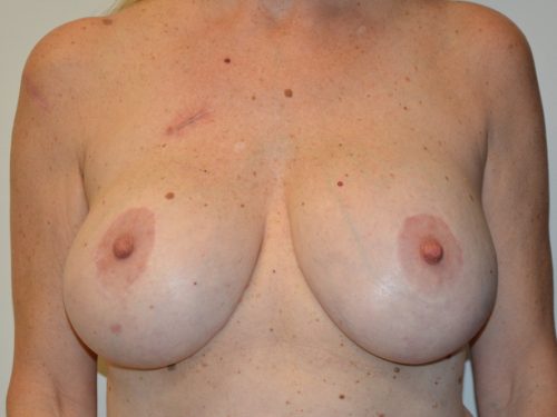 Breast Revision Before Patient 1