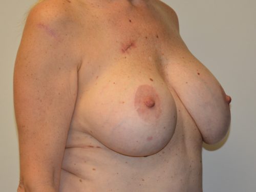 Breast Revision Before Patient 4