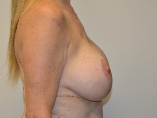 Breast Revision Before Patient 5