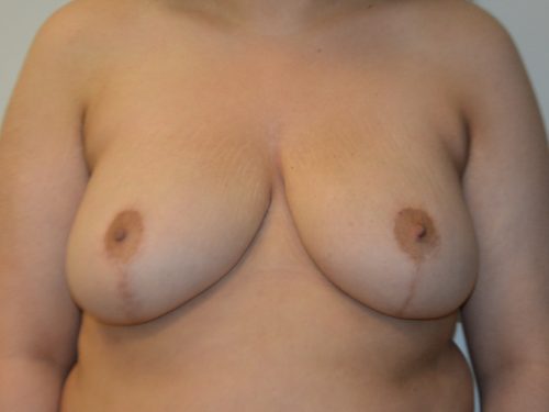 Breast Reduction After Patient 1