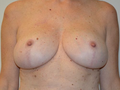 Breast Revision After Patient 1