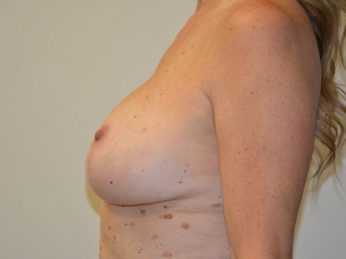 Breast Revision After Patient 3