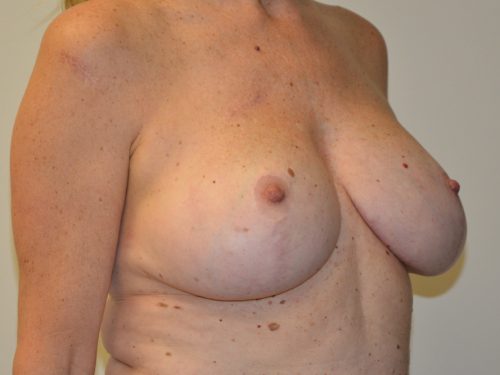 Breast Revision After Patient 4