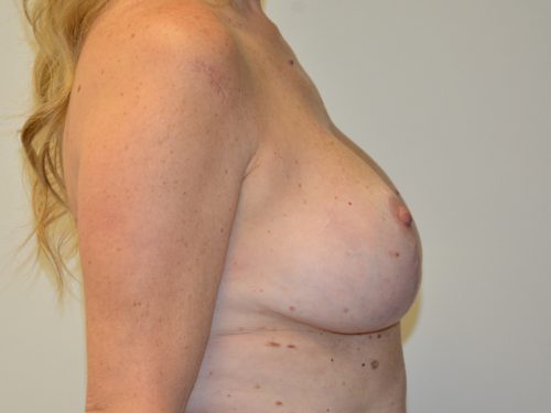 Breast Revision After Patient 5