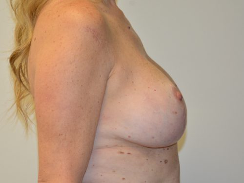 Breast Revision After Patient 5