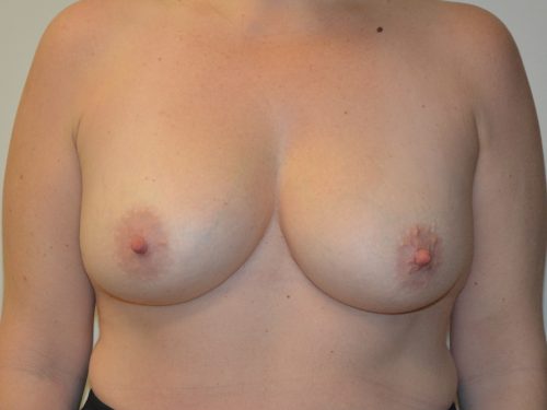 Breast Revision Before Patient 1
