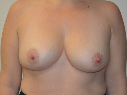 Breast Augmentation Before Patient 1