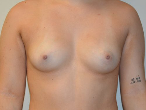 Breast Augmentation Before Patient 1