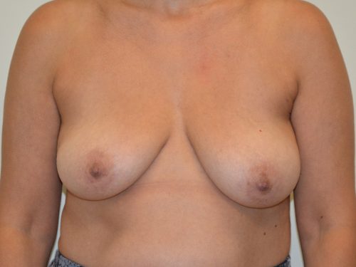 Breast Reconstruction Tissue Expanders Before Patient 1