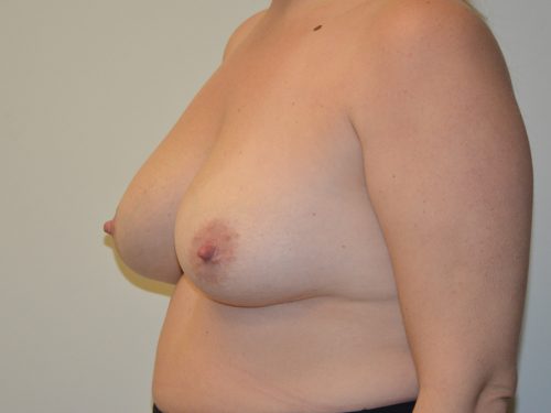 Breast Revision Before Patient 3