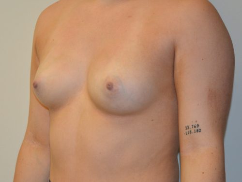 Breast Augmentation Before Patient 2