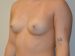 Breast Augmentation Before Patient Thumbnail 2