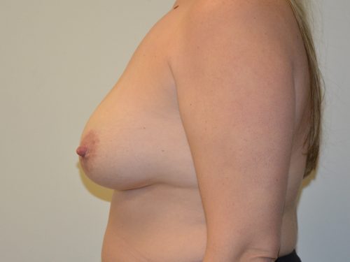 Breast Revision Before Patient 4