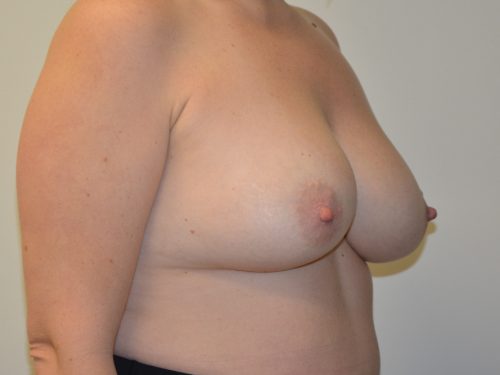 Breast Revision Before Patient 2