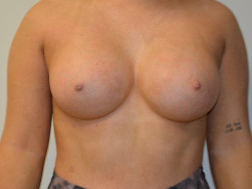 Breast Augmentation After Patient 1