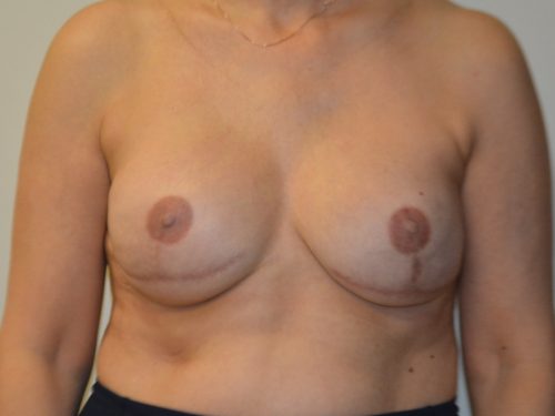 Breast Reconstruction Tissue Expanders After Patient 1