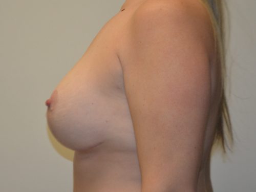 Breast Revision After Patient 4