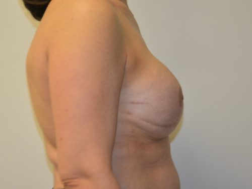 Breast Reconstruction Tissue Expanders After Patient 3