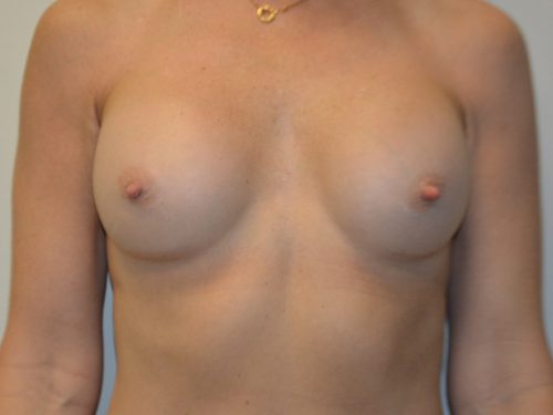 Breast Revision After Patient 1