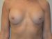 Breast Revision After Patient Thumbnail 1