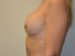 Breast Revision After Patient Thumbnail 3