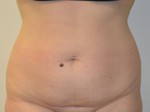 Tummy Tuck Before Patient 1