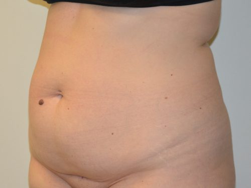 Tummy Tuck Before Patient 2